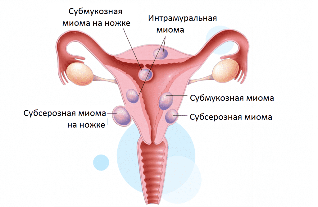 Миома матки – как проводится диагностика на ранних этапах?