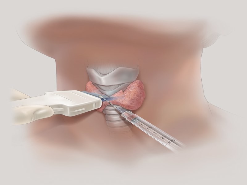 Биопсия железы: что это и как выбрать инструменты