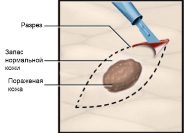 Что такое эксцизионная биопсия?