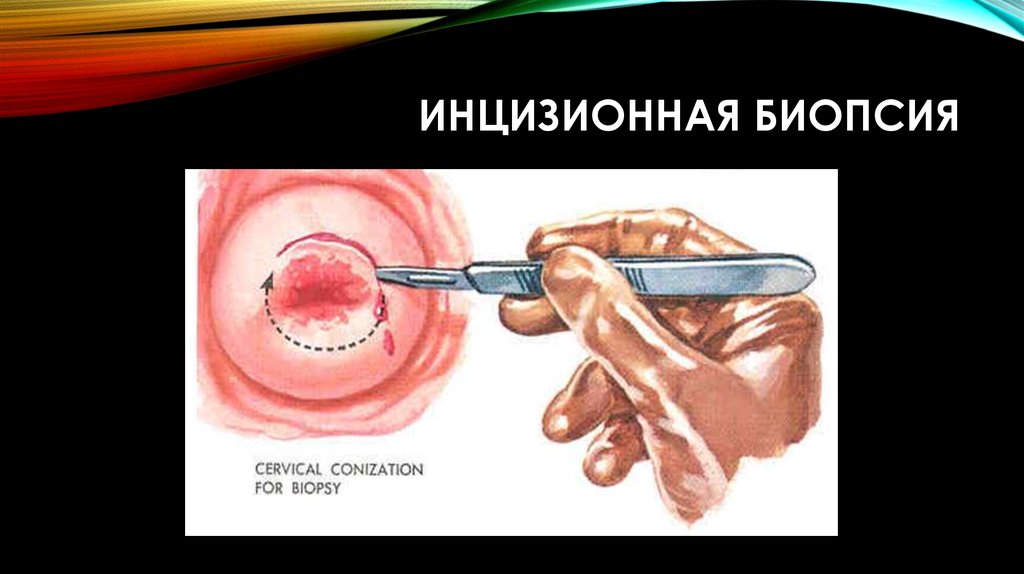 Какая есть разница между эксцизионной и инцизионной, пункционной и эндоскопической биопсиями?