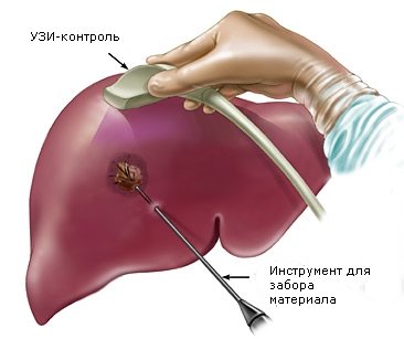 Что такое биопсия печени и когда показано ее проведение?