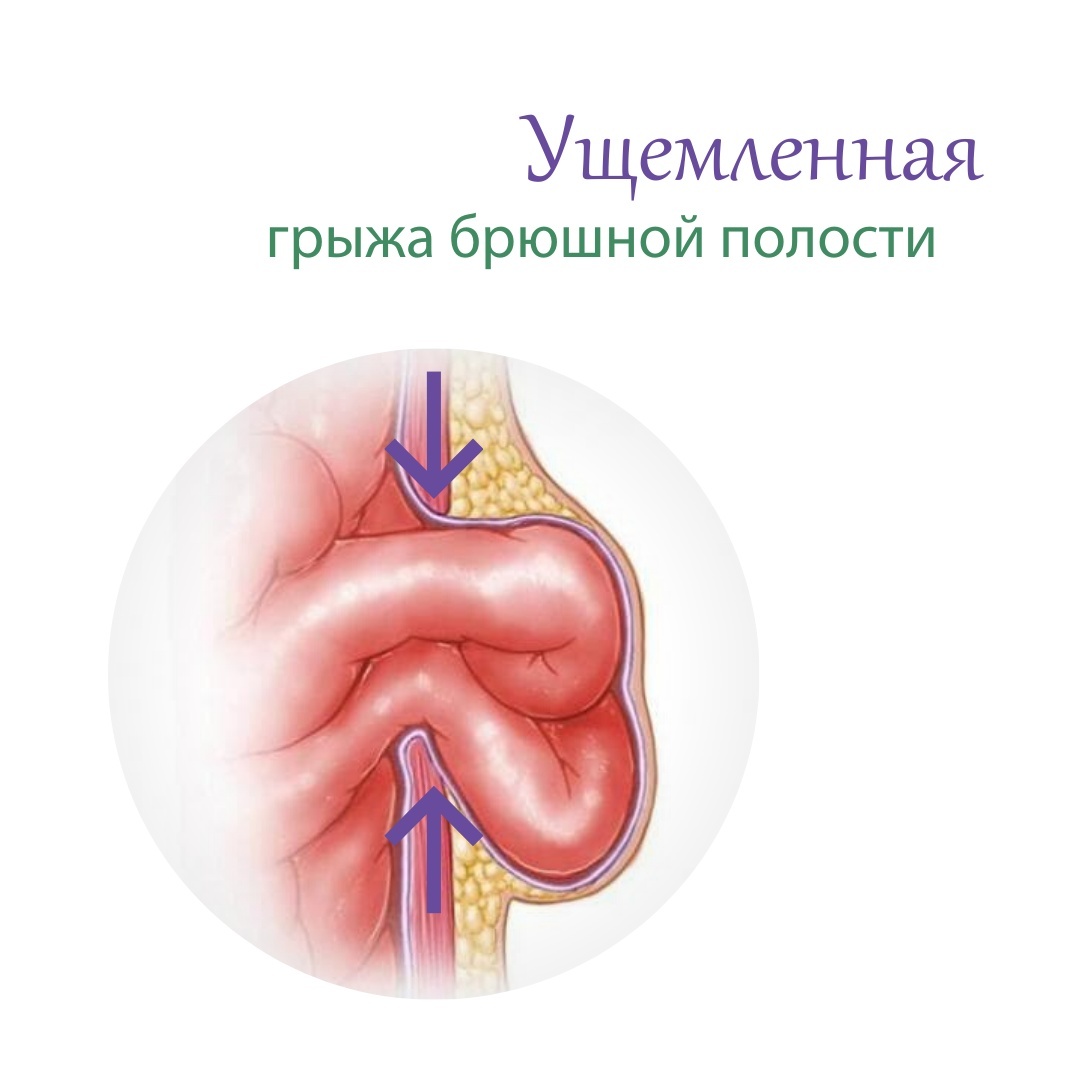 Ущемленная грыжа брюшной полости