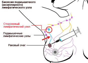 Что такое биосия сторожевых узлов?