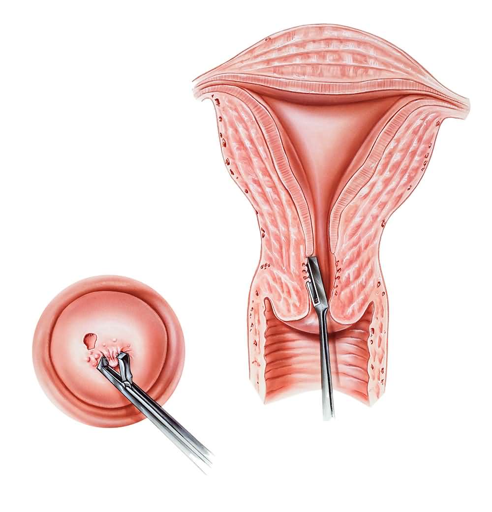 Методики проведения биопсии шейки матки