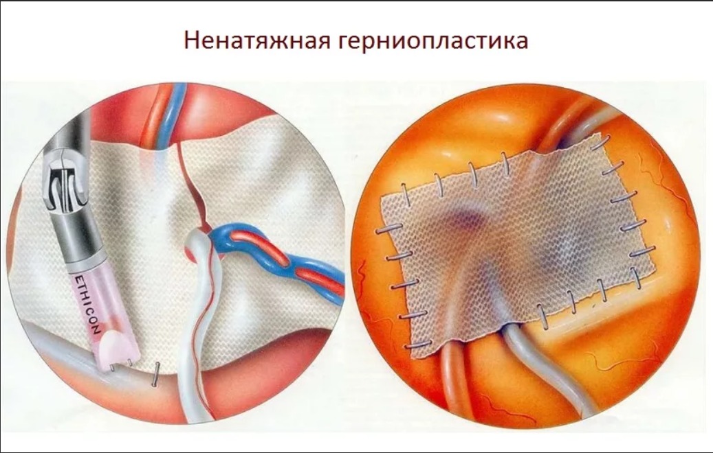 Пупочная грыжа: операция с сеткой и без сетки