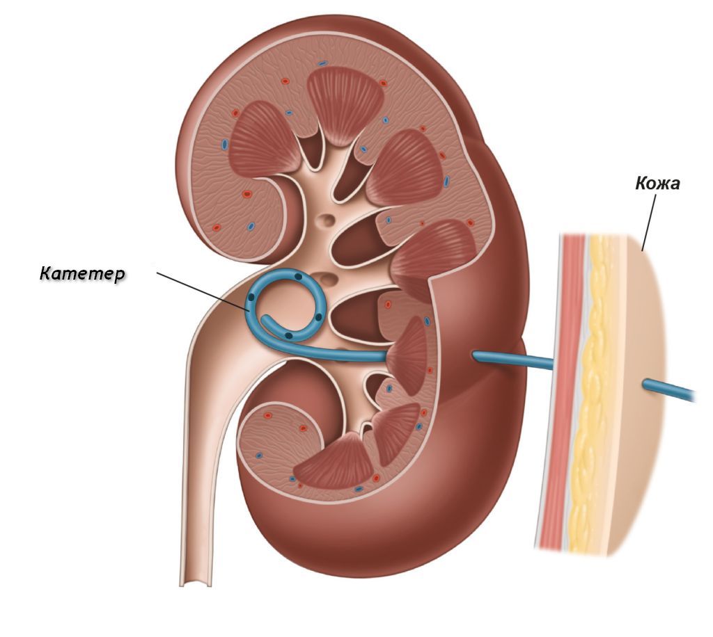 nefrostomicheskii_drenazh.jpg